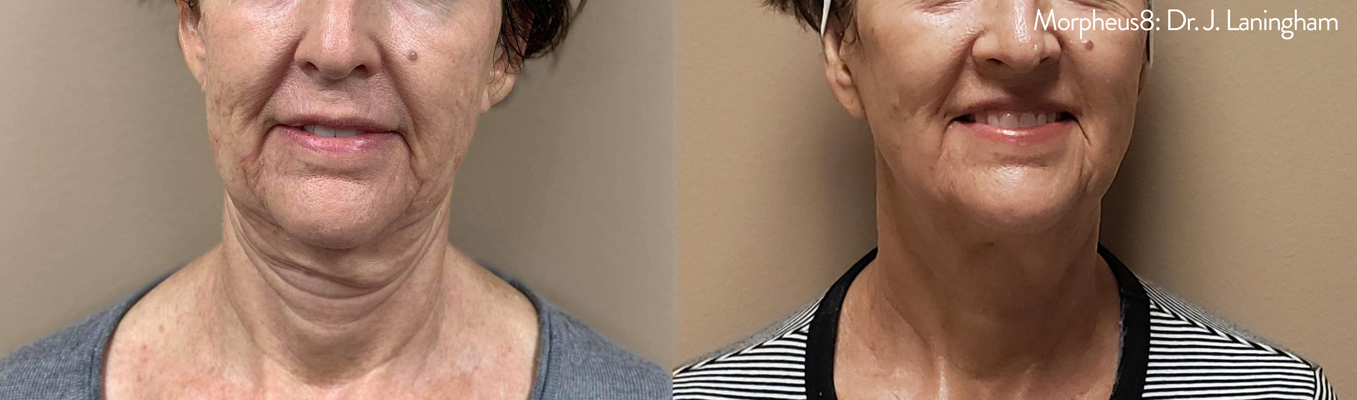 Non-Surgical Facelift Portland