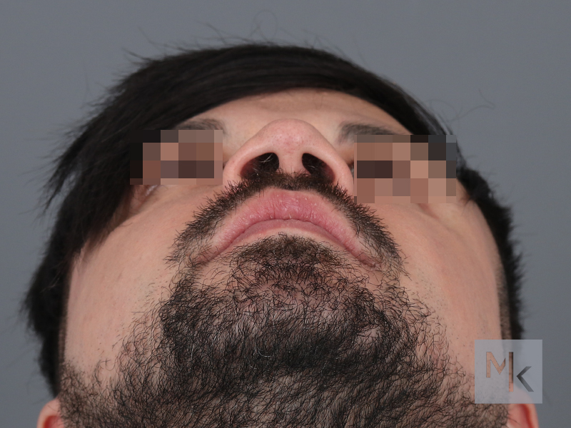 Alarplasty Before and After | Dr. Michael Kim