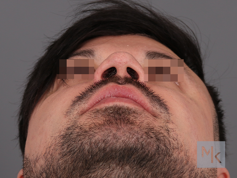 Alarplasty Before and After | Dr. Michael Kim