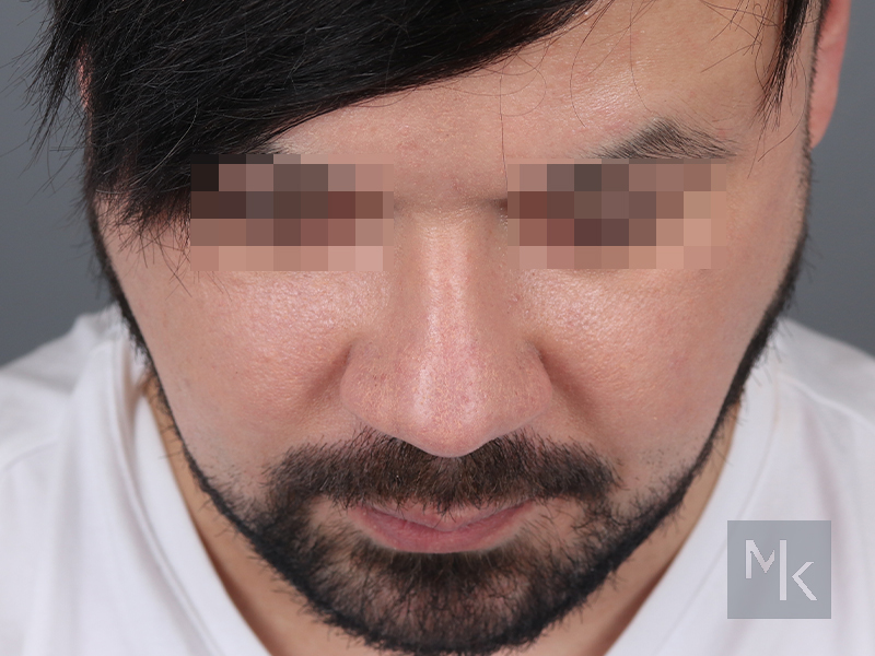 Alarplasty Before and After | Dr. Michael Kim