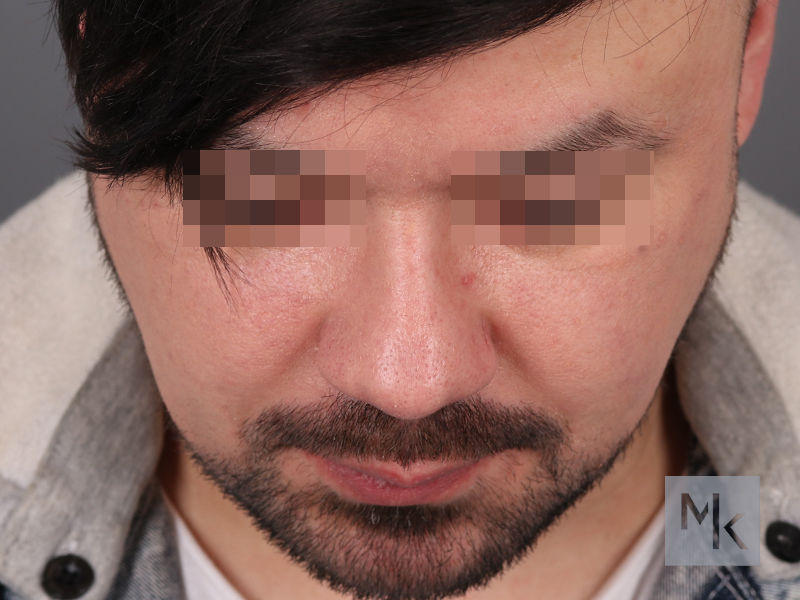 Alarplasty Before and After | Dr. Michael Kim