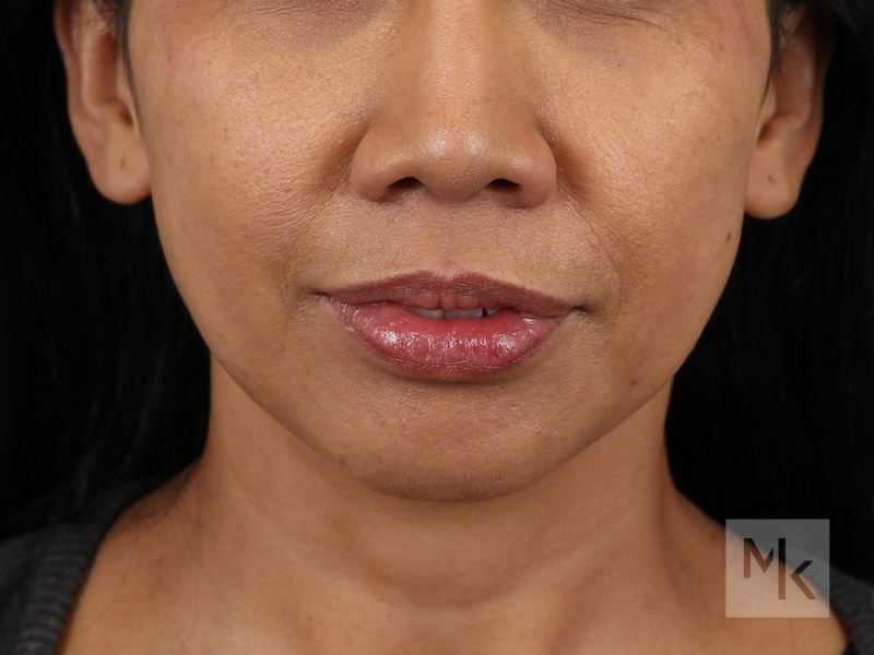 Alarplasty Before and After | Dr. Michael Kim