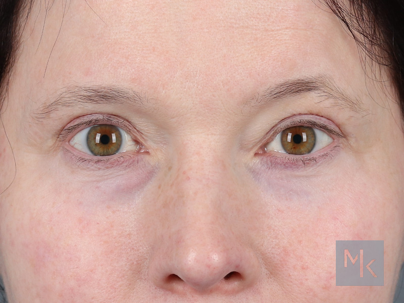 Upper Blepharoplasty Before and After | Dr. Michael Kim