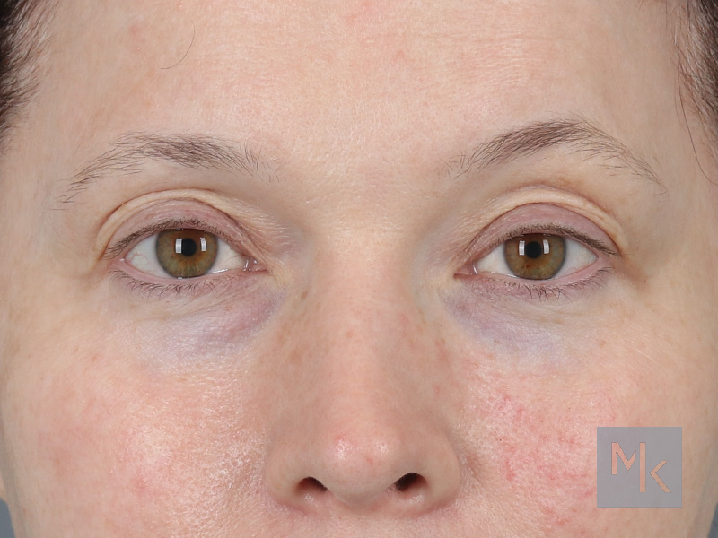 Upper Blepharoplasty Before and After | Dr. Michael Kim