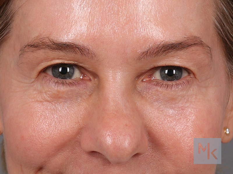 Upper Blepharoplasty Before and After | Dr. Michael Kim