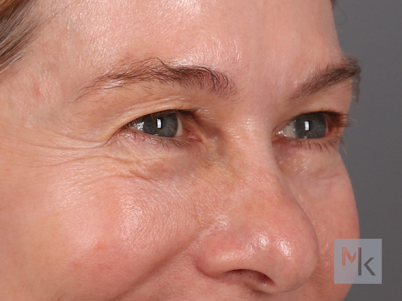 Upper Blepharoplasty Before and After | Dr. Michael Kim