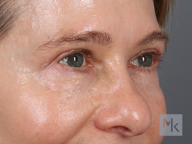 Upper Blepharoplasty Before and After | Dr. Michael Kim