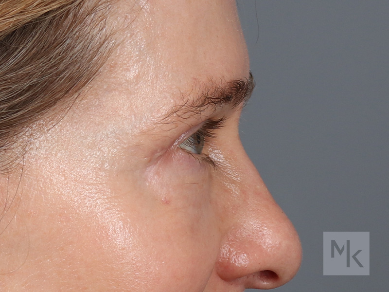 Upper Blepharoplasty Before and After | Dr. Michael Kim