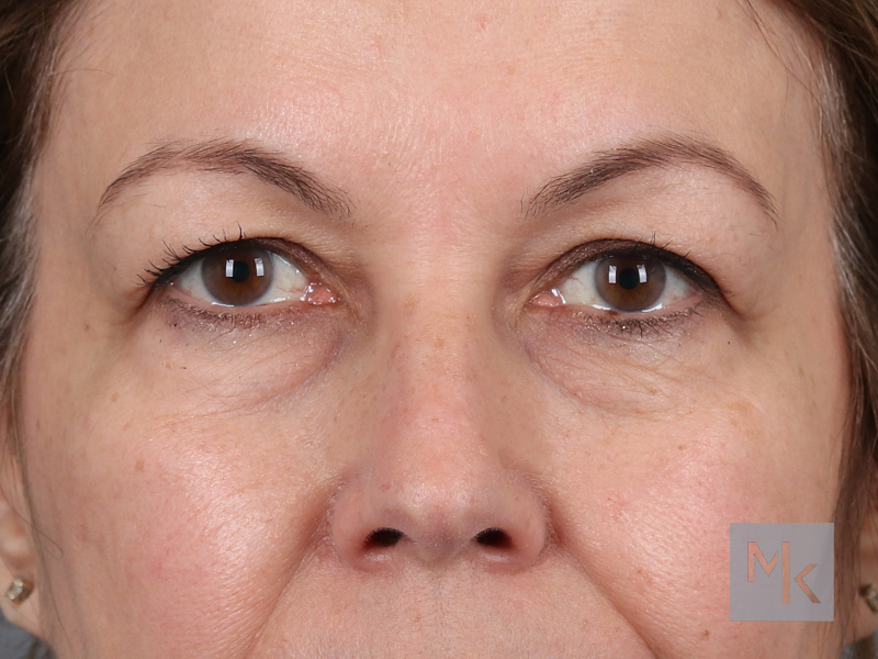 Upper Blepharoplasty Before and After | Dr. Michael Kim