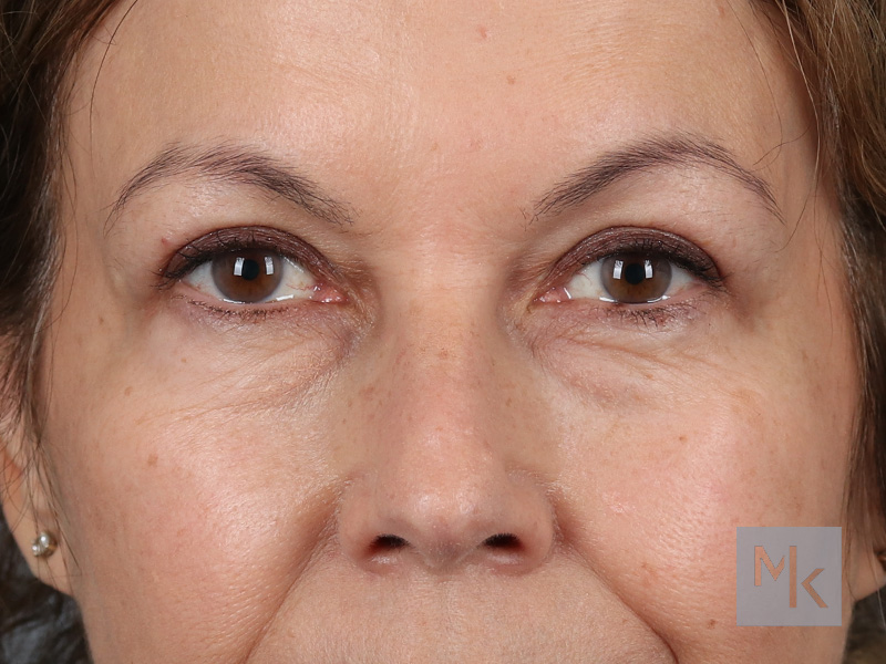 Upper Blepharoplasty Before and After | Dr. Michael Kim