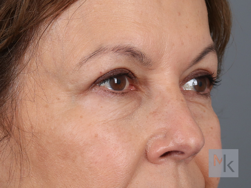 Upper Blepharoplasty Before and After | Dr. Michael Kim