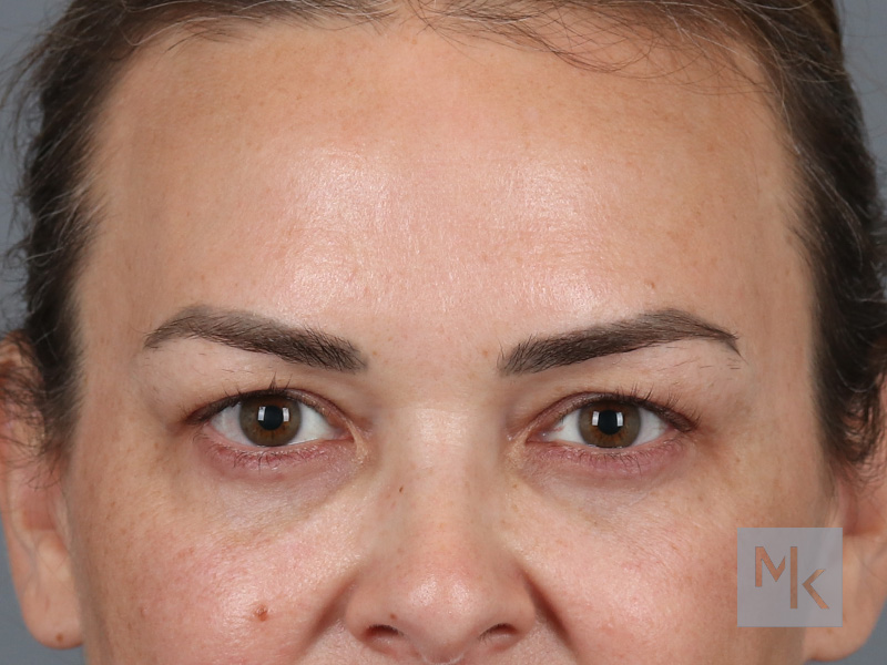 Upper Blepharoplasty Before and After | Dr. Michael Kim