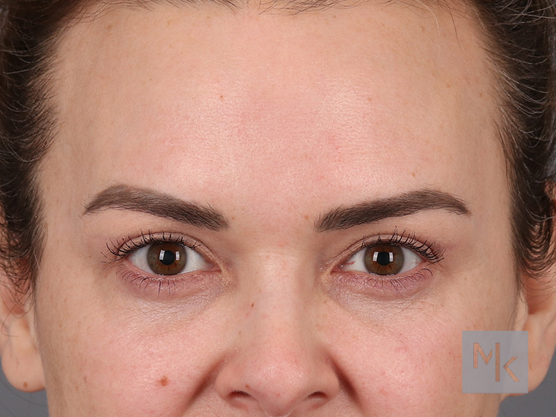 Upper Blepharoplasty Before and After | Dr. Michael Kim