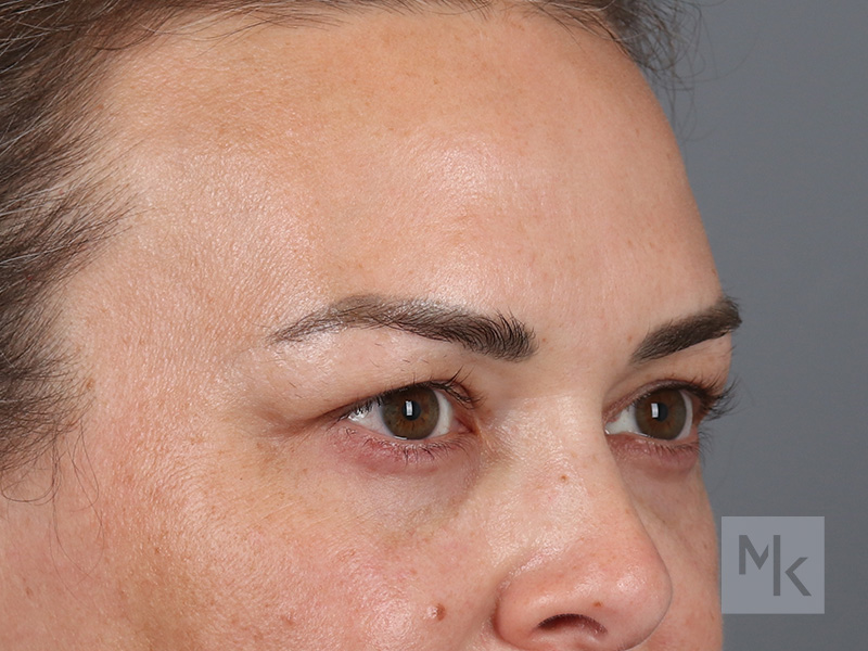 Upper Blepharoplasty Before and After | Dr. Michael Kim