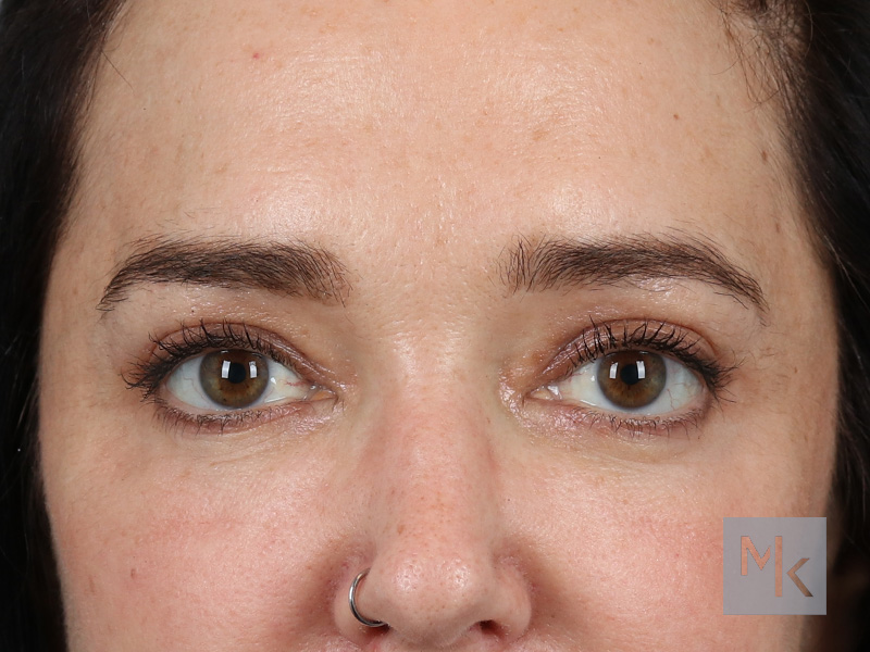 Upper Blepharoplasty Before and After | Dr. Michael Kim