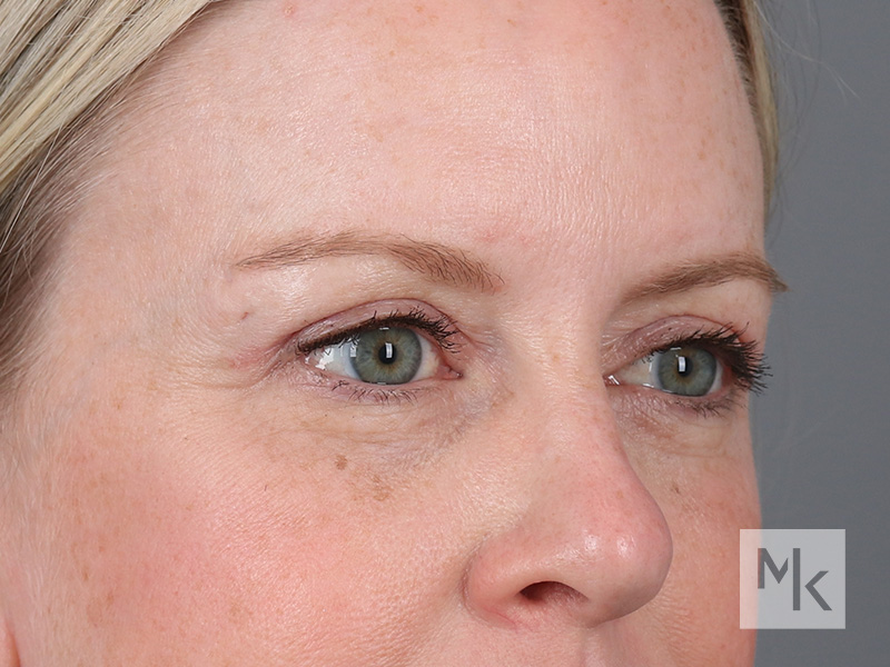 Blepharoplasty Before and After | Dr. Michael Kim