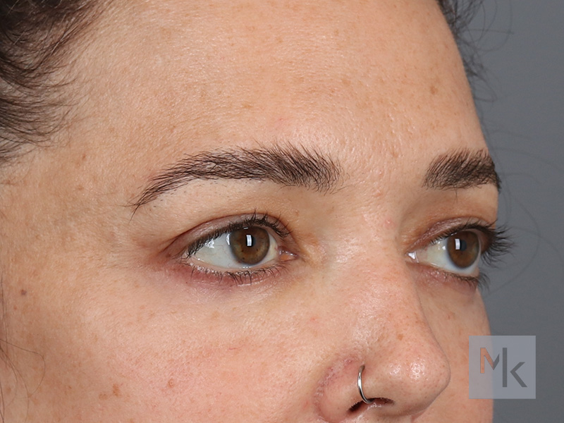 Upper Blepharoplasty Before and After | Dr. Michael Kim