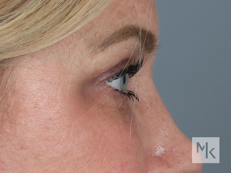 Upper Blepharoplasty Before and After | Dr. Michael Kim