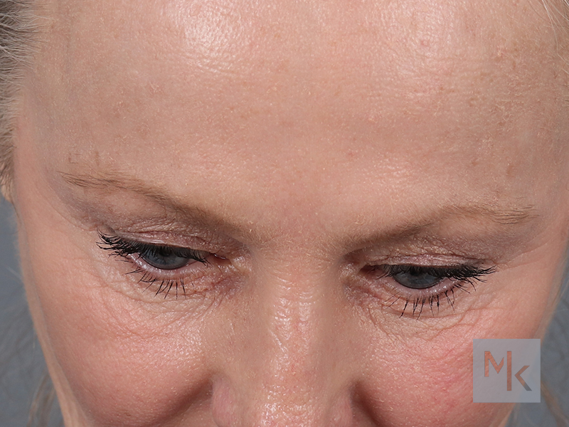 Brow Lift Before and After | Dr. Michael Kim