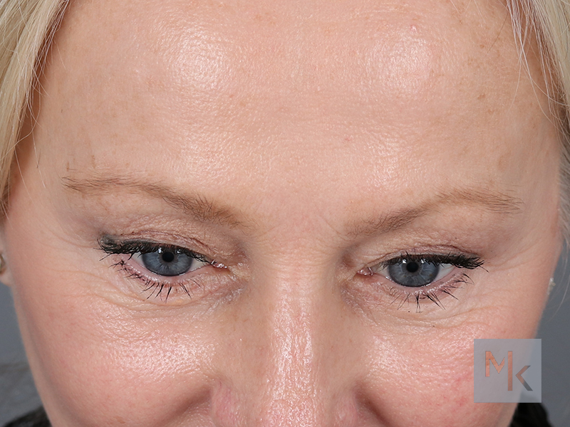 Brow Lift Before and After | Dr. Michael Kim