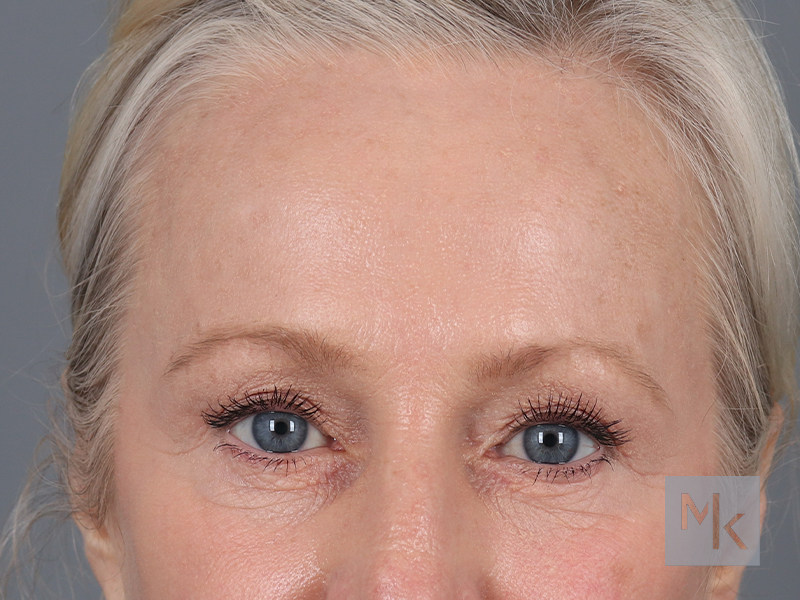 Brow Lift Before and After | Dr. Michael Kim