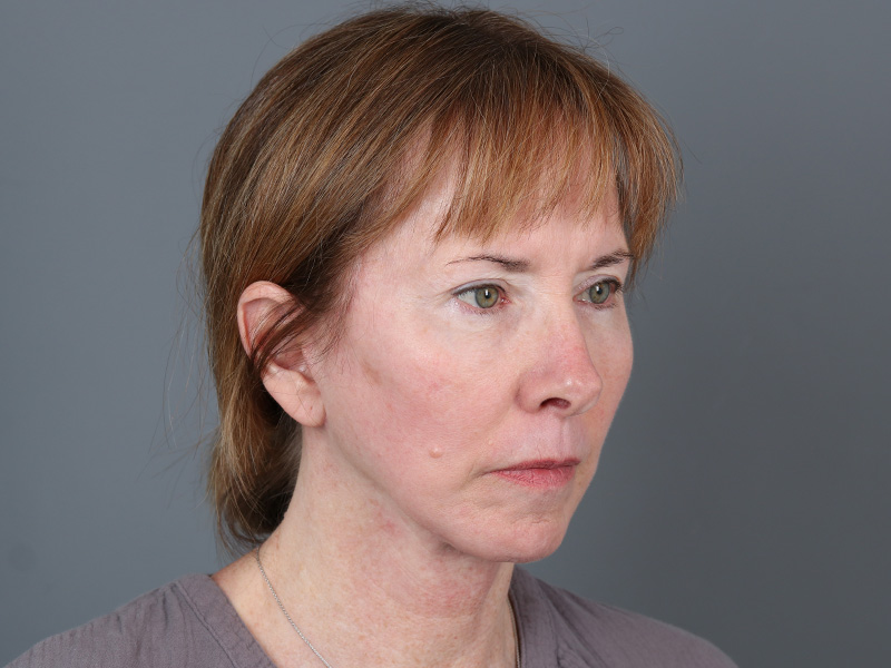 Brow Lift Before and After | Dr. Michael Kim