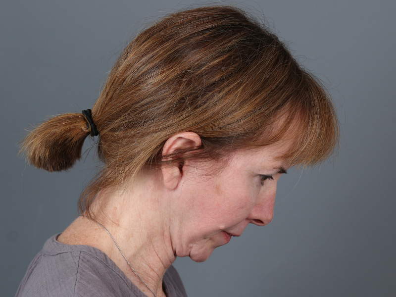 Brow Lift Before and After | Dr. Michael Kim