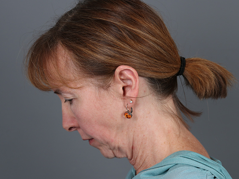 Brow Lift Before and After | Dr. Michael Kim