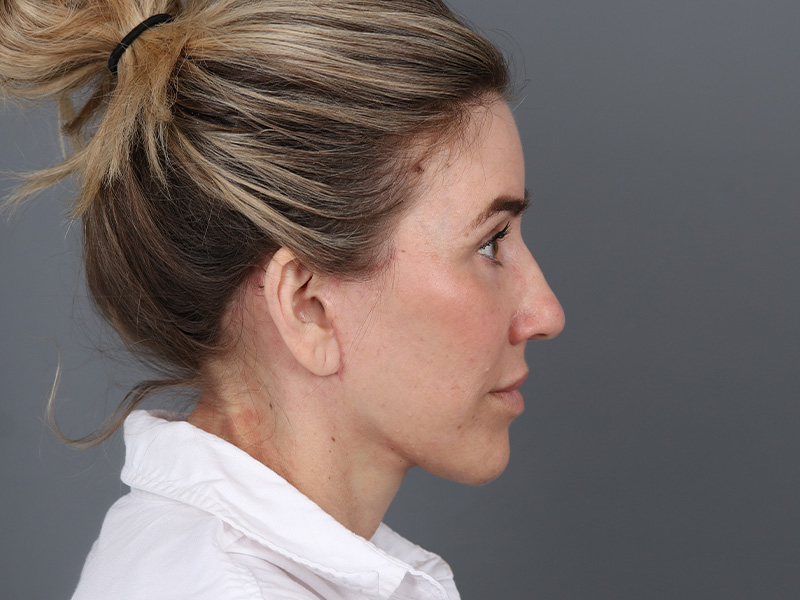Brow Lift Before and After | Dr. Michael Kim