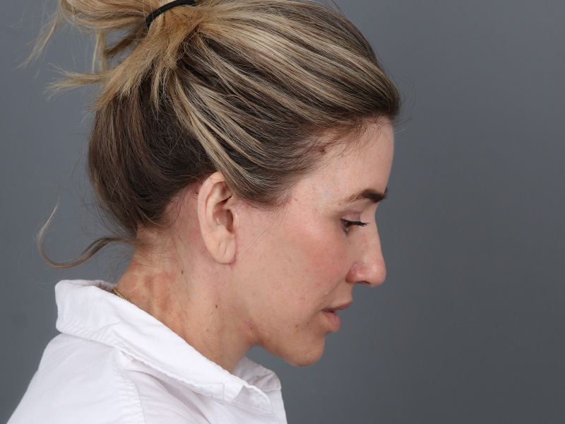 Brow Lift Before and After | Dr. Michael Kim