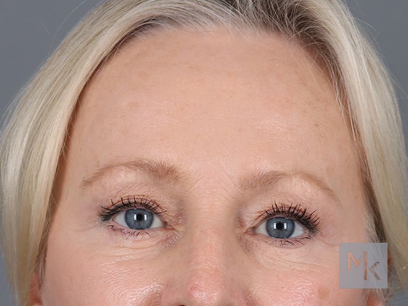 Brow Lift Before and After | Dr. Michael Kim