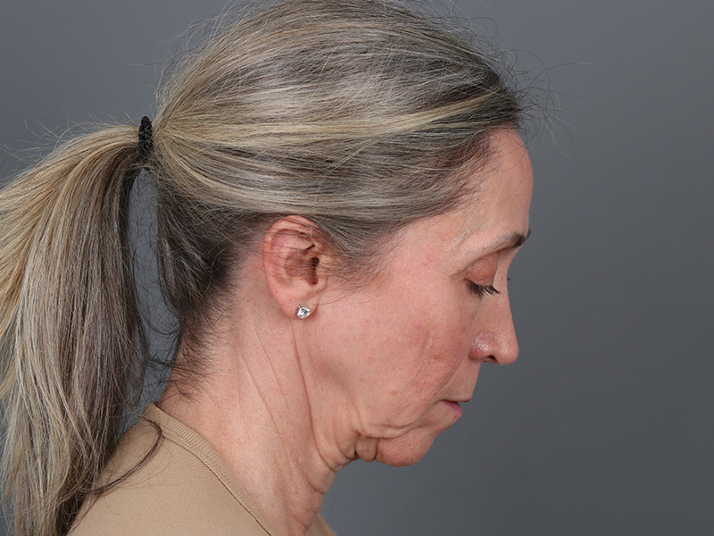Brow Lift Before and After | Dr. Michael Kim