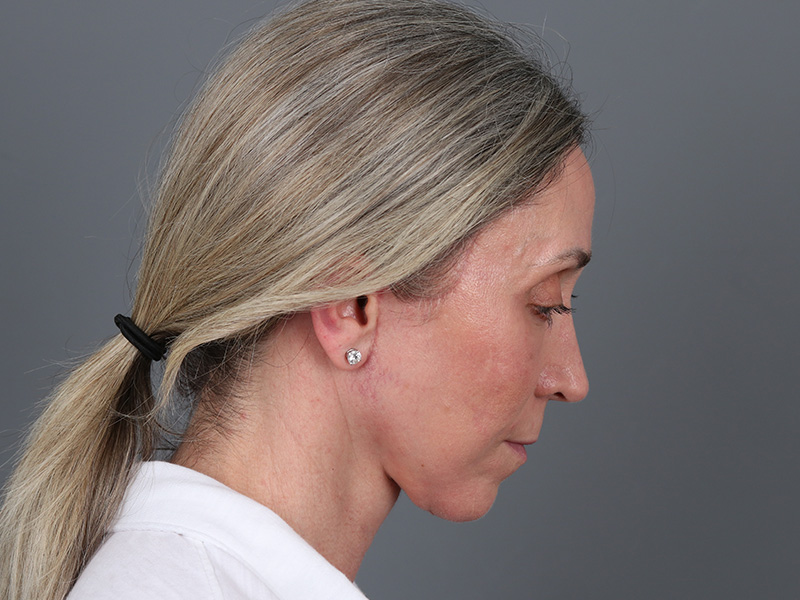 Brow Lift Before and After | Dr. Michael Kim