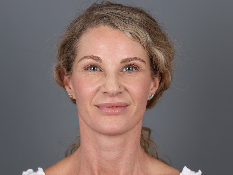 Brow Lift Before and After | Dr. Michael Kim