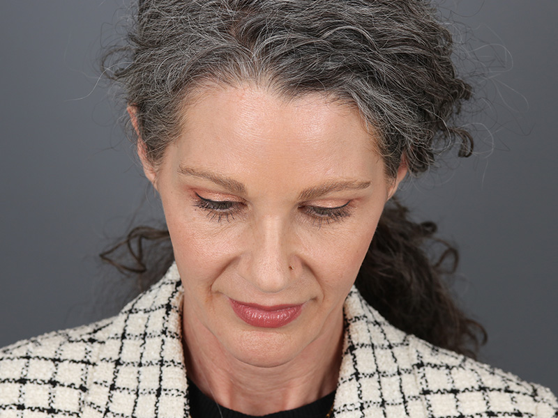 Brow Lift Before and After | Dr. Michael Kim