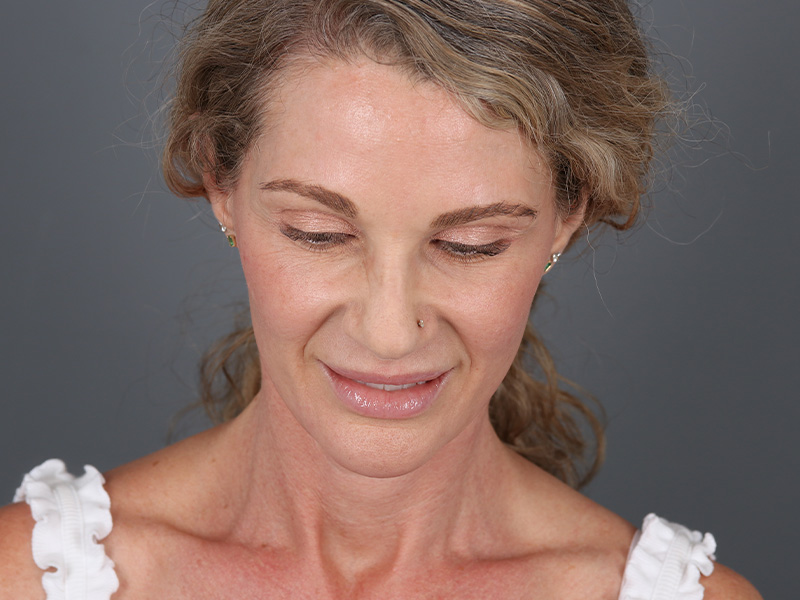 Brow Lift Before and After | Dr. Michael Kim