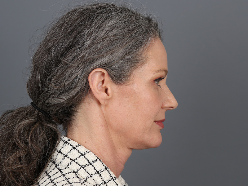 Brow Lift Before and After | Dr. Michael Kim