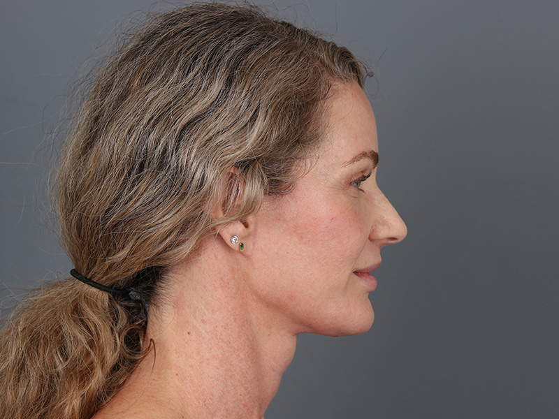 Brow Lift Before and After | Dr. Michael Kim