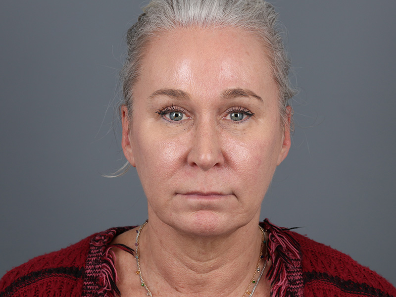 Brow Lift Before and After | Dr. Michael Kim