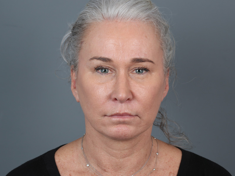 Brow Lift Before and After | Dr. Michael Kim