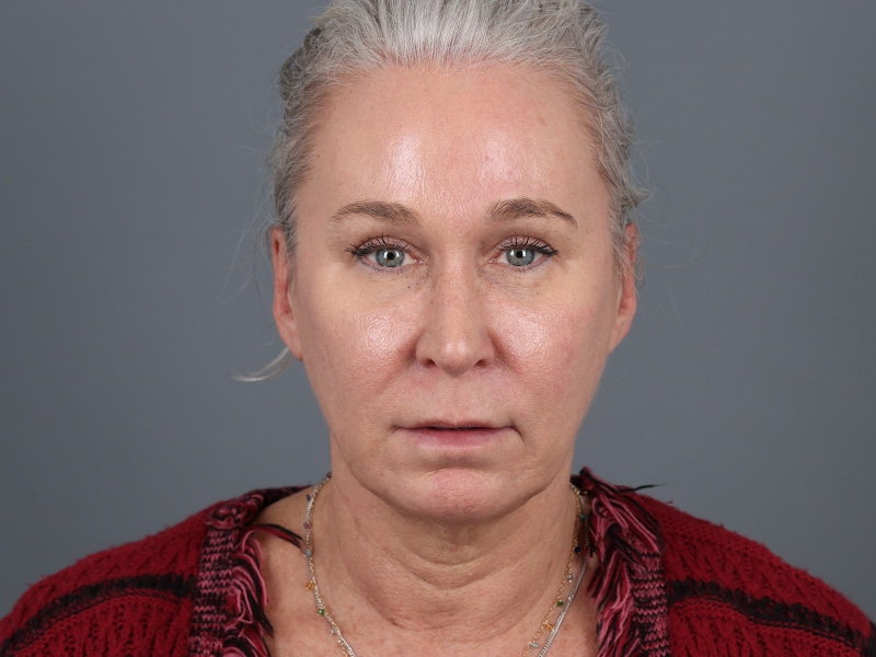 Brow Lift Before and After | Dr. Michael Kim