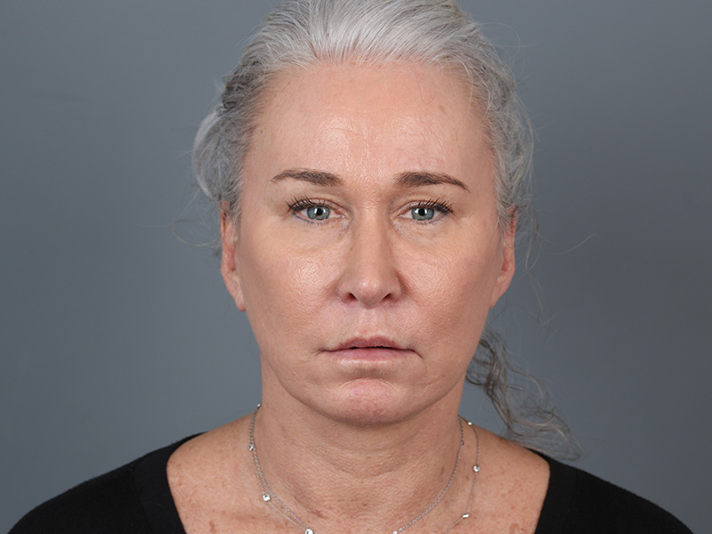Brow Lift Before and After | Dr. Michael Kim