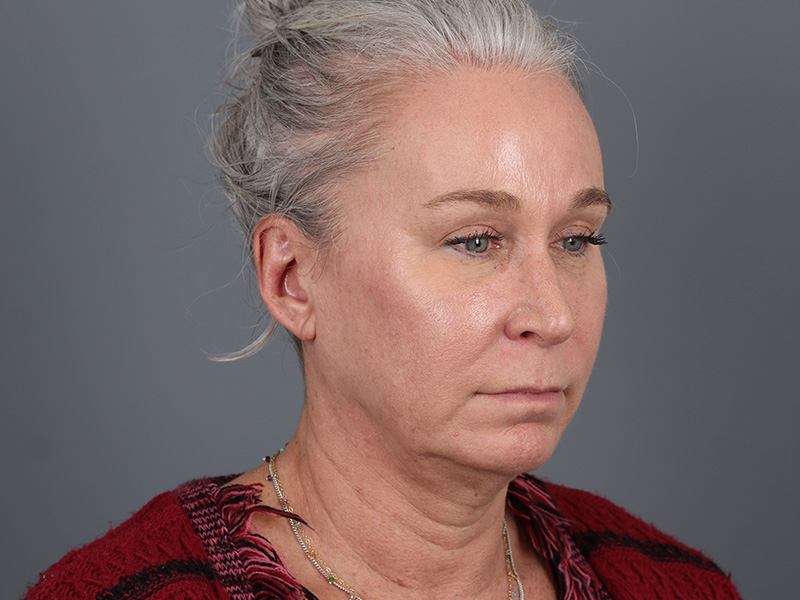 Brow Lift Before and After | Dr. Michael Kim