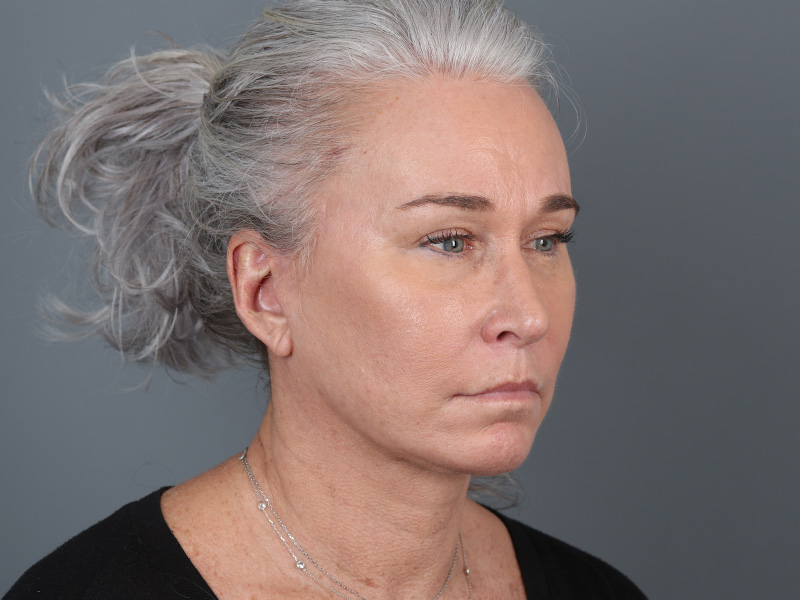 Brow Lift Before and After | Dr. Michael Kim