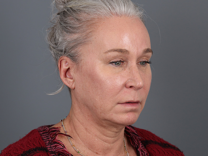Brow Lift Before and After | Dr. Michael Kim