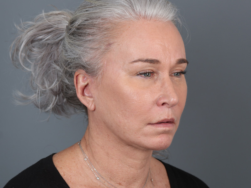 Brow Lift Before and After | Dr. Michael Kim