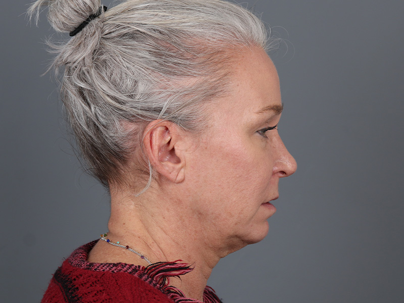 Brow Lift Before and After | Dr. Michael Kim