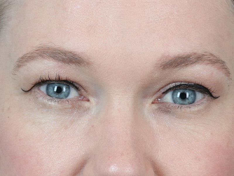 Brow Lift Before and After | Dr. Michael Kim