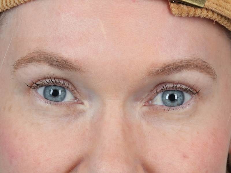 Brow Lift Before and After | Dr. Michael Kim