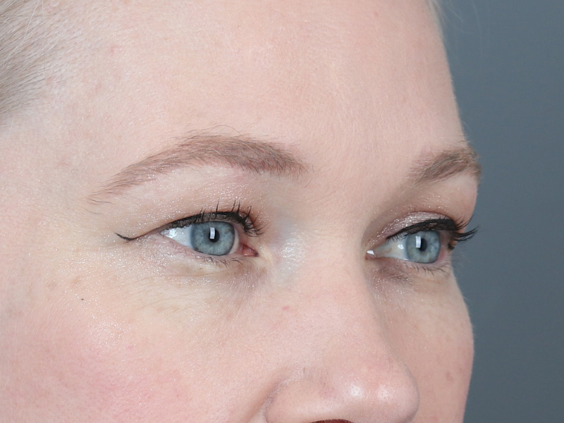 Brow Lift Before and After | Dr. Michael Kim